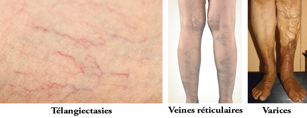 E-Dermatologie | Varice varicoza reticulare